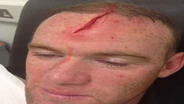Rooney Pasang Foto Lukanya di Facebook
