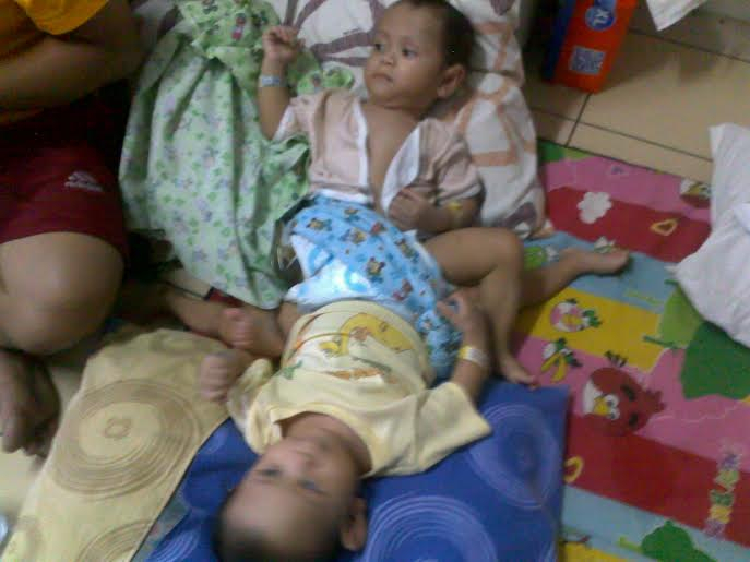 Ini Alasan RS Hasan Sadikin Tak Operasi Bayi Kembar Dempet Anus