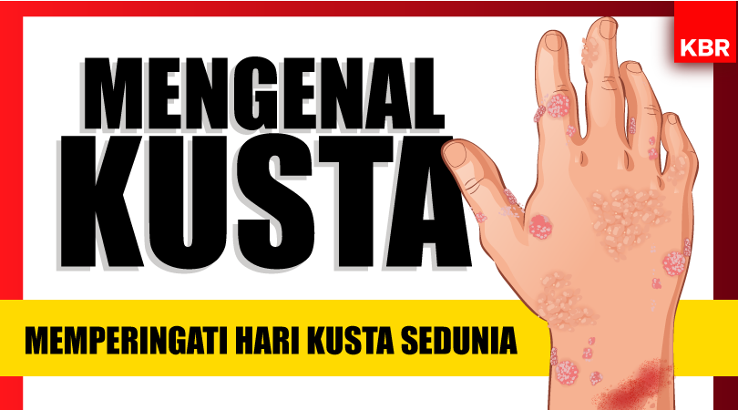 Mungkinkah Indonesia Bebas Kusta?
